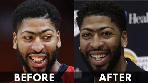 anthony davis teeth before and after
